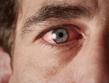 Αυτό το σημάδι στα μάτια μπορεί να είναι πρώιμο σύμπτωμα για… Αλτσχάιμερ